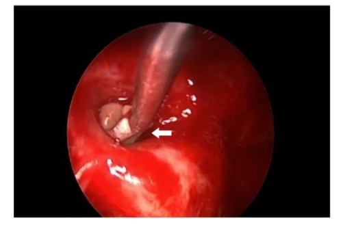  White arrow shows in intraoperative image that the lesion was found as a yellow colour, soft and avascular shape 
