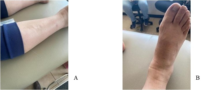 Puncture of points (A) Luo E40 FENG LONG and (B) Yuan B3 TAIBAI, own elaboration based on the clinical file of case study 2025.