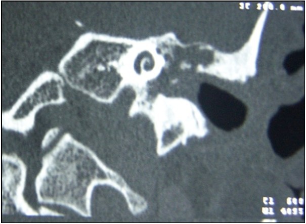  Soft tissue image causing bone erosion on temporal CT
