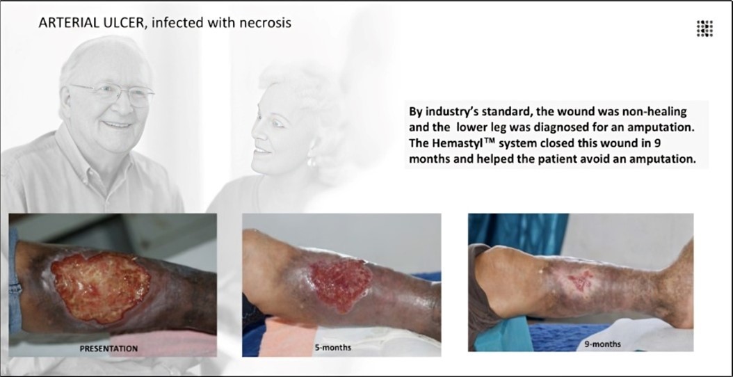The wound met clinical criteria for a non-healing lesion, and the patient was indicated for lower-leg amputation. The Hemastyl™ System supported sustained periwound recovery and culminated in complete closure at 9 months, negating the need for surgical amputation.