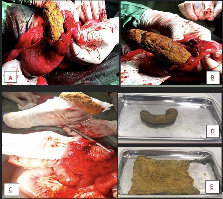A picture showing the intraluminal mass within the lumen of the jejunum (A) which was milked slowly out of the bowel (B). The defect in the bowel (C) is seen after the mass is completely out. The mass (D) was opened up to show its character (E), a surgical sponge.
