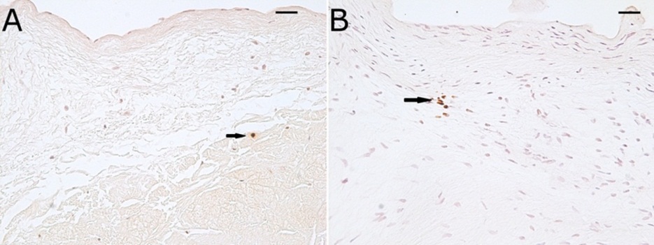  Photomicrographs of Runx2 immunohistochemistry of a normal (A) and myxomatous (B) mitral valve demonstrating minimal staining for Runx2. Scale bars = 25 μm.