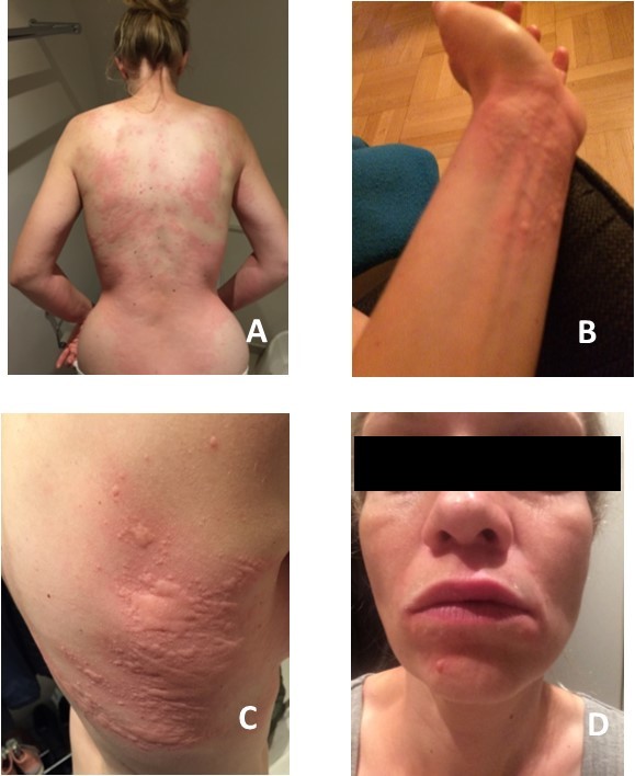  A) Urticarial rash of the back B) Urticarial rash on the wrist C) Urticarial rash and angioedema of the thorax – note the angioedematous areas where the patient has been scratching (characteristic pattern) D) Angioedema of lips and periorbital area.