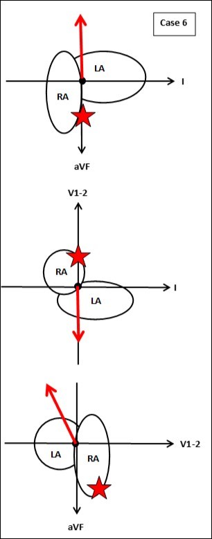  Reconstruction of the atrial activation site (star) by back projection in three planes. The common origin of the Lead I, aVF, V1-2 (or x,y,z) coordinate system is located in the middle of the interatrial septum. Arrows on axes indicate positive directions from the origin. The tail of each vector is located at the origin. The arrow head of each vector is located at a point defined by the P wave amplitudes in Leads I, aVF, and V1-2 , as listed in Table 1 for Case 6. In this particular example P wave vectors (thick arrows) are constructed from the origin in each plane, as follows. Frontal plane (top): Lead I, 0; aVF, -4; vector points toward the head. Horizontal plane (middle): Lead I, 0; average of V1 and V2, -2; vector points toward the back. Sagital plane (bottom): average of V1 and V2, -2; aVF, -4; vector points toward the back shoulder. An imaginary line is back projected from the head of each vector, through the tail of the vector at the origin, until it intersects with the superimposed sketch of the atrial wall (intersection point in three dimensions indicated by stars). This point of intersection is the putative electrophysiological origin of the tachycardia. RA right atrium; LA left atrium. In this case the actual source was in the low tricuspid annulus, which is inferior and anterior to the midpoint of the interatrial septum. 