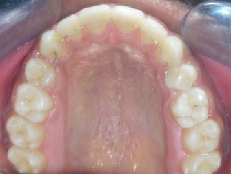 Post expansion - maxillary arch