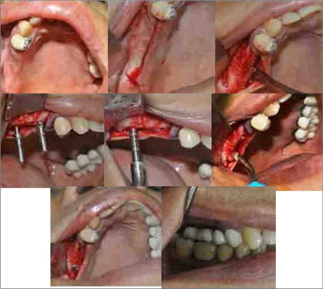  (a-f) Direct sinus membrane elevation carried-out under complete aseptic conditions and local anaesthesia with vasoconstrictor (2% lignocaine with 1:80,000 adrenaline) in cases with residual bone height of <5mm where a lateral spherical bone window was created using the lateral sinus approach technique; no membrane covering was used to cover the defect; 