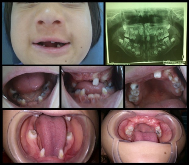 Intra oral photographs and panoramic radiograph: anodontia of mandibular and maxillary incisors, absence of mucobuccal fold in maxillary and mandibular anterior region, congenital absence of the incisors, conical shaped teeth and multiple frenula.