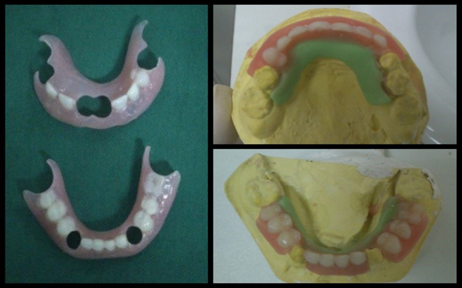  Partial denture: acrylic partial dentures were prepared after tooth extraction and healing of sockets.