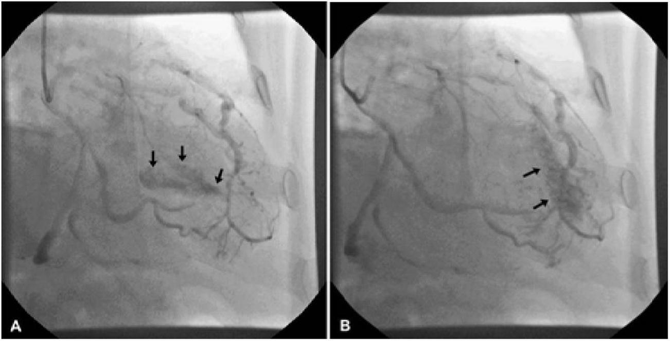  A/B. Left anterior descending artery fistula in left ventricular cavity: an angiography perspective.