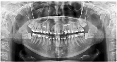  Panoramic X-ray before the removal of the third molars.