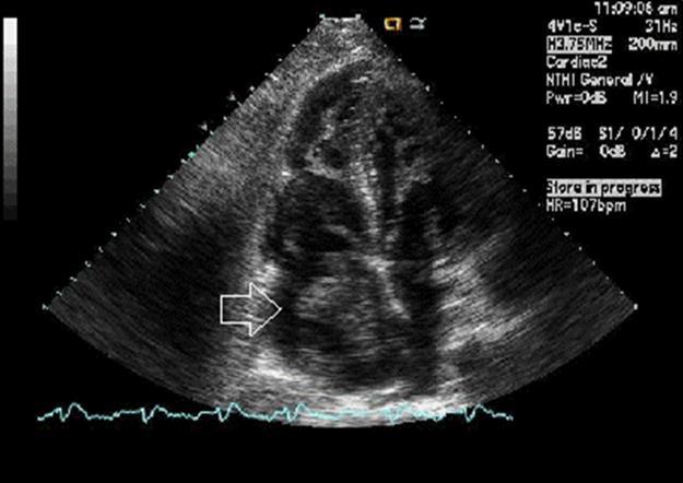  Echographic image of Case 1 of the large, mobile thrombus in the right atrial cavity.