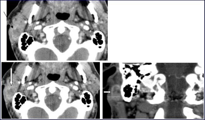  Computed Tomography of the neck with intravenous contrast material revealed a focal lesion in the right parotid gland with size 3 × 2-cm. The mass was well defined, heterogeneous, with peripheral contrast enhancement (large white arrow). It had a central attenuation value of 13 HU, suggesting a necrotic mass without bony involvement (thin black arrow).