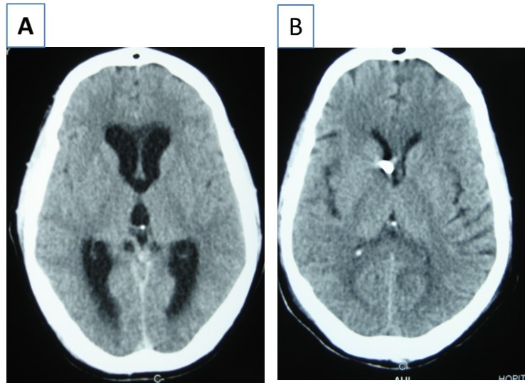  cerebral CT scan with axial view showing  acute hydrocephalus (A) and control after external ventricular drainage (B)