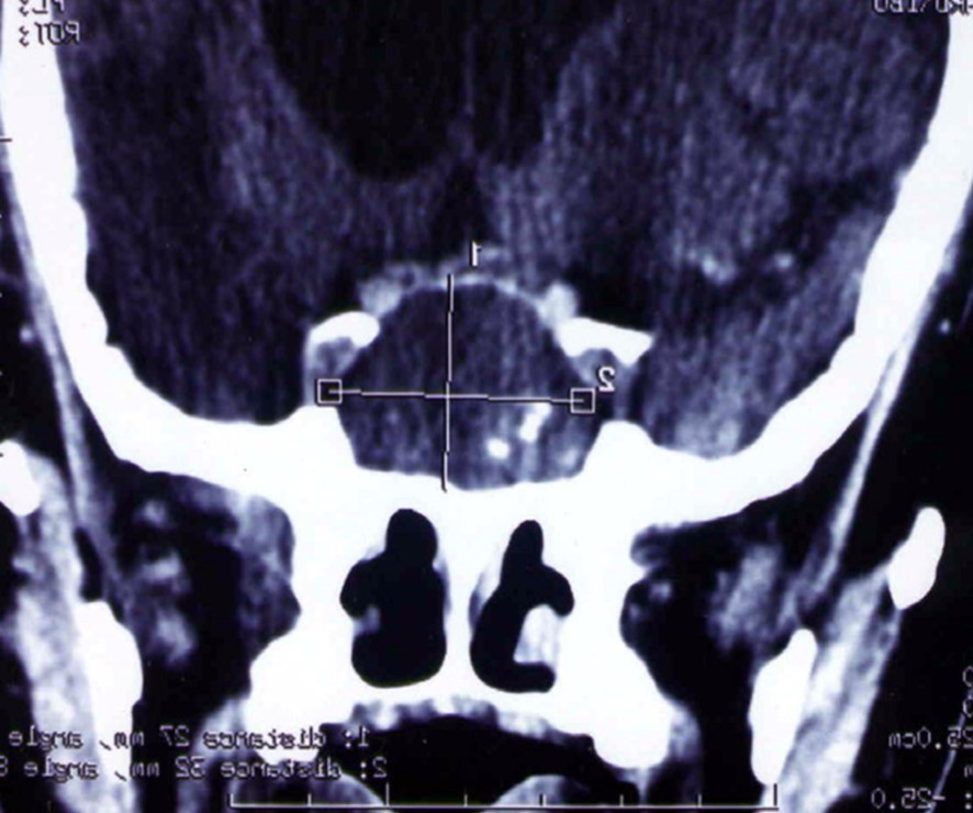  CT scan showing a hypodense mass enlarging the sphenoid sinus and sellar region with calcification like images and bone erosion of the sellar floor 