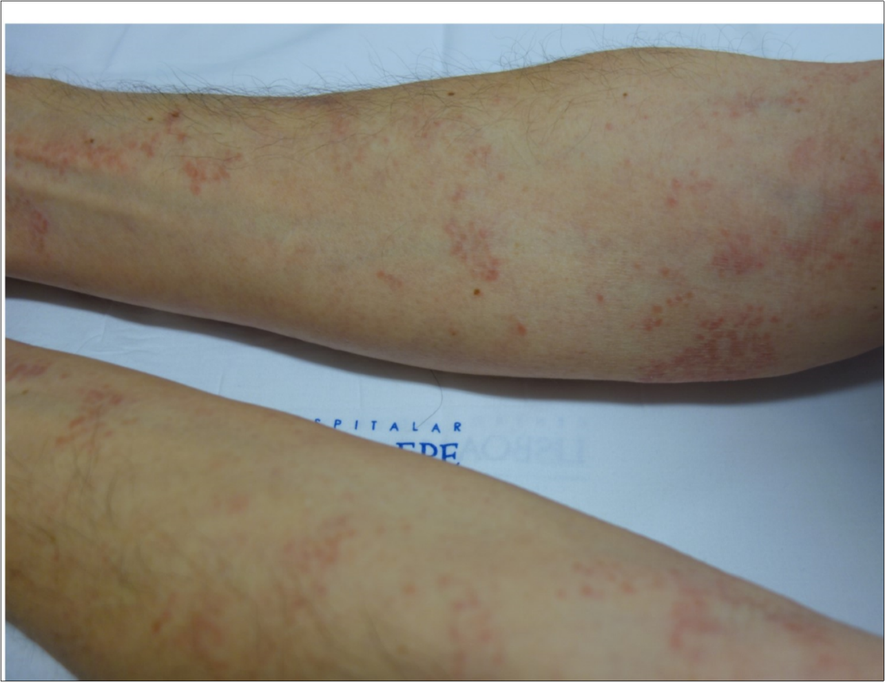  Red-brown patches and papules on the upper limbs.