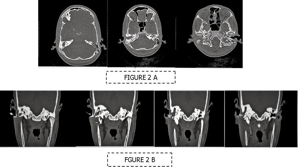  (A-B) HRCT imaging. (A) Right canal atresia with soft tissue density behind it (B) CT sino-gram showing multiple (arrow marked) sinuses communicating to right middle ear cavity.