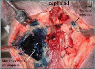 Methylene blue suboccipital decompression dissection . One the right is the dye on the occipital nerve form a standard occipital nerve block. On the left is the dye from the stealth decompression bathing the occipital nerve. (Image Courtesy of Gabor Racz, MD)