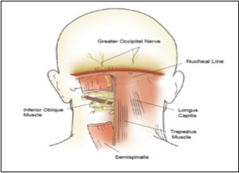  Path of the greater occipital nerve. (Image courtesy of Epimed    International®, with permission) 