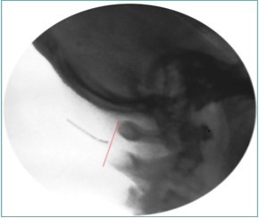  Lateral fluoroscopic image showing the needle in the suboccipital space; red shows the level of the spinous processes (red line). Image Courtesy of Gabor Racz, MD