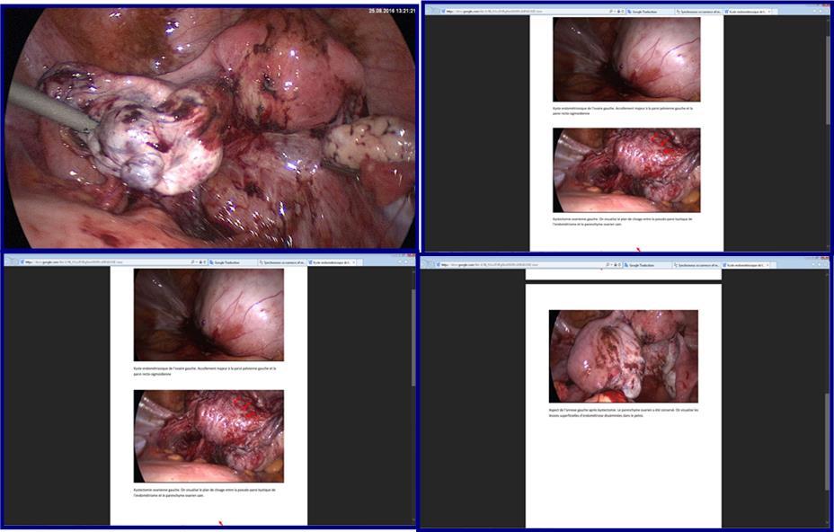  Surgical finding showing (a, b) left ovarian cystectomy. We visualize the cleavage plane between the pseudo-cyst wall of endometria and the healthy ovarian parenchyma. (c) Appearance of left remaining adenexa after cystectomy. (d) Ovarian parenchyma was preserved. 