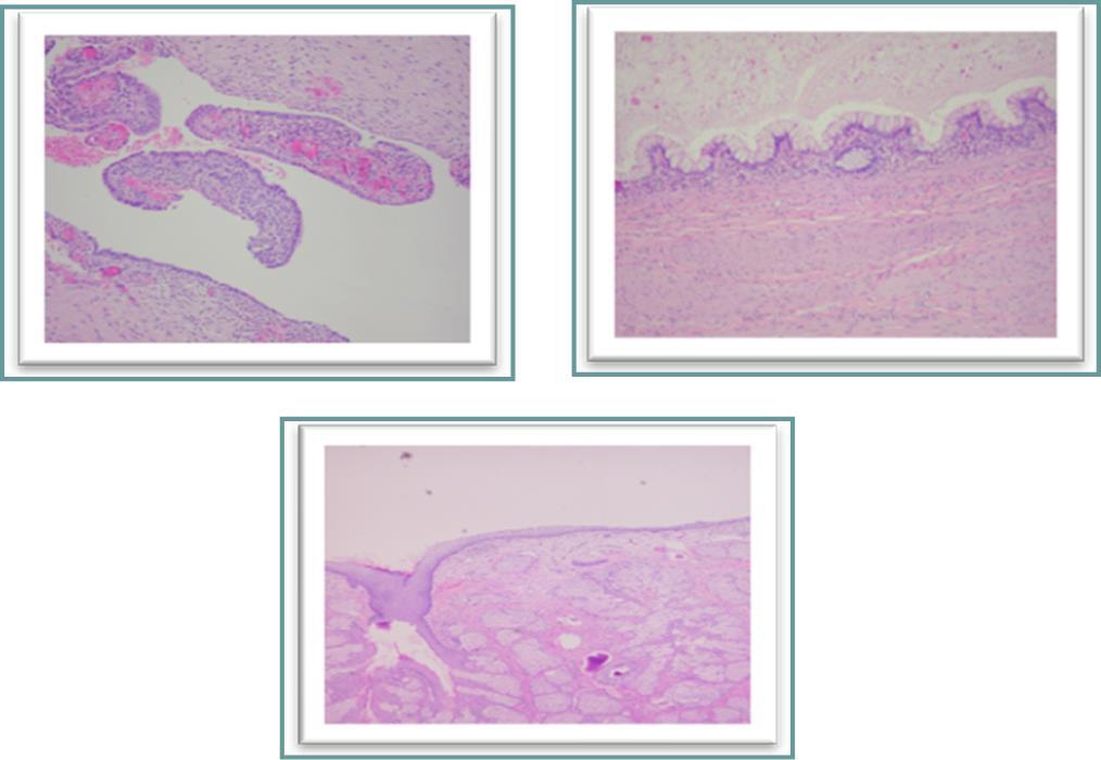  Histological examination.  a, cyst lined by endometrial epithelium overcoming its endometrial stroma corresponding to an endometriosis cyst.  b, a portion of the cystic mature teratoma lined with intestinal-type mucosa.  c, skin surface-like structure with many sebaceous glands found on another part of the cyst.