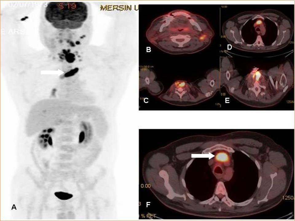  MIP (Maximum intensity Projection-A) and axial PET-CT fusion (B-F) images demonstrate recurrent mass lesion, metastatic lymphadenopaties and tumor thrombus (white arrows).