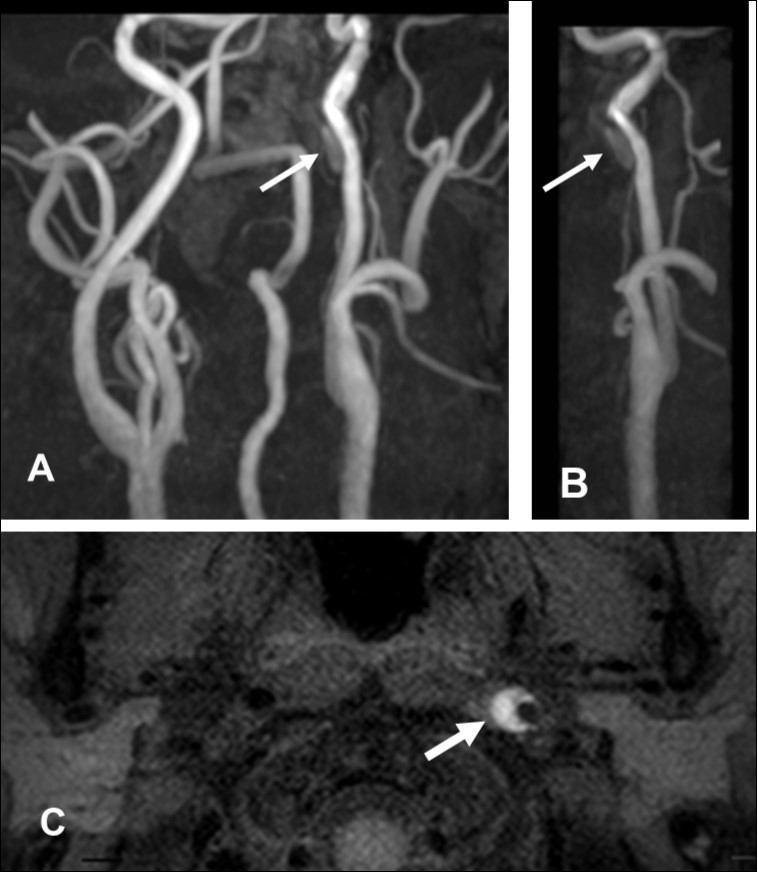  First hospitalization. A. Maximum intensity projection ( MIP )image of arteries in the cervical segment. B. Magnetic resonance angiography of the left carotid artery. C. T1 VISTA sequence. Note the flow void reflective of the narrowed lumen next to intramural hematoma (hyperintense crescent)