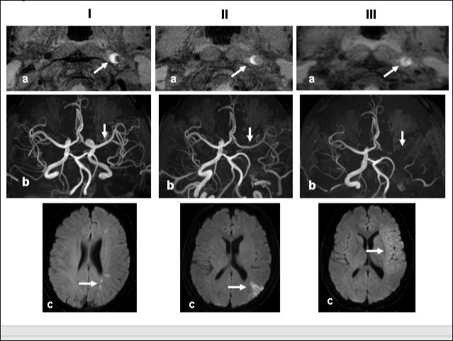  Time course Columns I, II, and III are images obtained 1, 2, and 3 weeks, respectively, after the start of dissection of the cervical segment of the internal carotid artery. Ia, IIa, IIIa.T1 VISTA images of the same segment shown in Fig. 1C. The dark area reflective of the low void progresses to hyperintensity by week 3. IIIa shows complete occlusion of the true lumen by the intramural hematoma (arrow ). Ib, IIb, IIIb.  TOF-MRA images of the intracranial arteries. (a) The left MCA is supplied via antegrade flow from the left carotid artery (arrow). (b) Flow from the left carotid artery disappeared from the ICA bifurcation to the top of the ICA. Blood supply to the left MCA derives from the circle of Willis via the anterior- or the posterior communicating artery (arrows). By week 3, flow to the left MCA, even via the left A1 segment of the anterior cerebral artery had disappeared completely. Ic, IIc, IIIc.  Diffusion-weighted images at the basal ganglia level. Week 1: a few hyperintense areas are visualized in the border zone of the left cerebrum (arrow). Week 2: Note the hyperintensity area in the watershed zone between the left ACA and the MCA, and between he MCA and the PCA (arrow). The image acquired on week 3 shows a diffuse hyperintensity area in the left MCA territory (arrow).