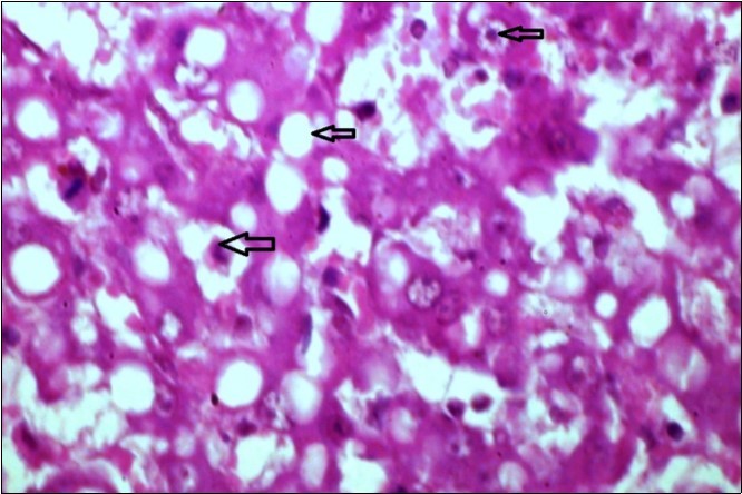  liver (dead cattle less than 1 year old) showed hepatocytes suffering hydropic degeneration. And necrosis  (H&E, X 60).