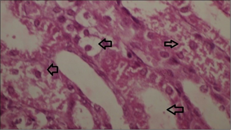  kidneys (dead cattle less than 1 year old) showed severe hydropic degeneration of renal tubular epithelium accompanied by dilated renal tubules, vesicles formations and casts (arrows). (H&E, X 100)