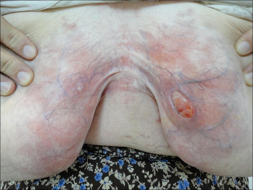  There were erythema, severe cutaneous atrophy and widespread vascular ectasias located all over the intermamarian region and two punched out ulcers were present on the medial sides of her breasts