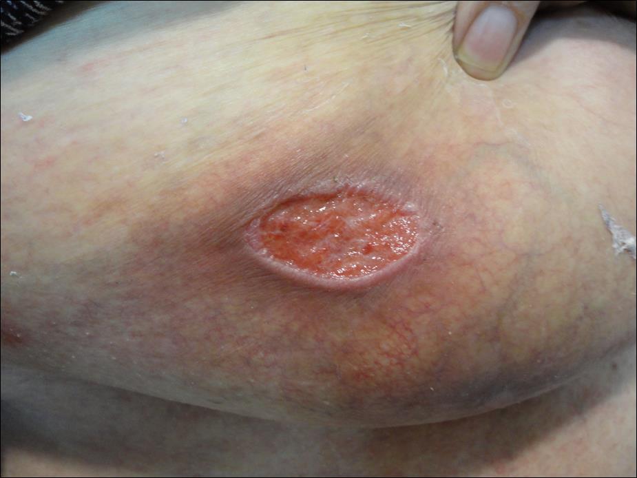  Case two: There were mild erythema, cutaneous atrophy and telangiectases located over the lateral side of her right breast.