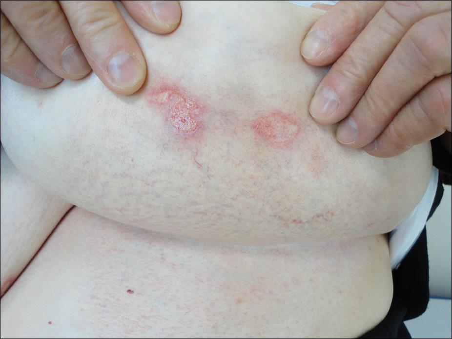  Case three: Mild erythema, mild cutaneous atrophy, fine telangiectases and superficial punched out ulcers with erythematous clear bases located in the inframamarian region on the left side.