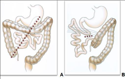  —Schematic drawings of normal rotation and malrotation (from Pickhart et Bhalla, 2002). A, Drawing shows that normal 270° rotation and fixation of midgut results in familiar positioning of bowel with broad mesenteric attachment (dotted line). B, Drawing shows that malrotation results in malpositioned bowel and narrow base of mesenteric fixation (dotted line), which is prone to midgut volvulus. Abnormal fibrous peritoneal bands of Ladd (curved lines) that attach to right colon predispose to internal hernia in older patients.