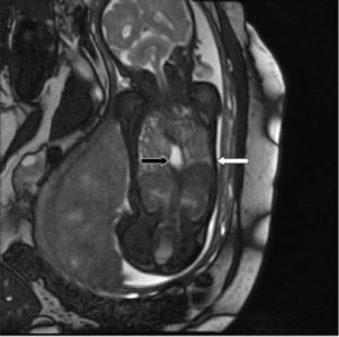  MRI demonstrating the entire fetal stomach (black arrow) in the thoracic cavity. The white arrow points to the fetal diaphragm.