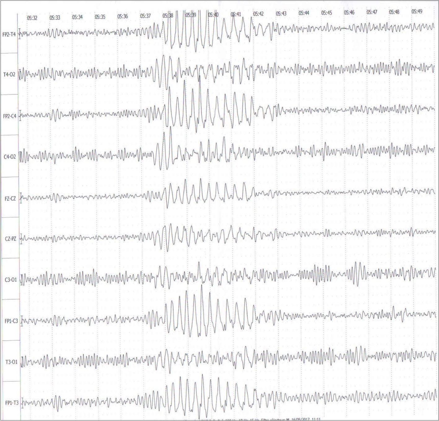  EEG Sleep records showed brief discharges of generalized slow waves and spikes