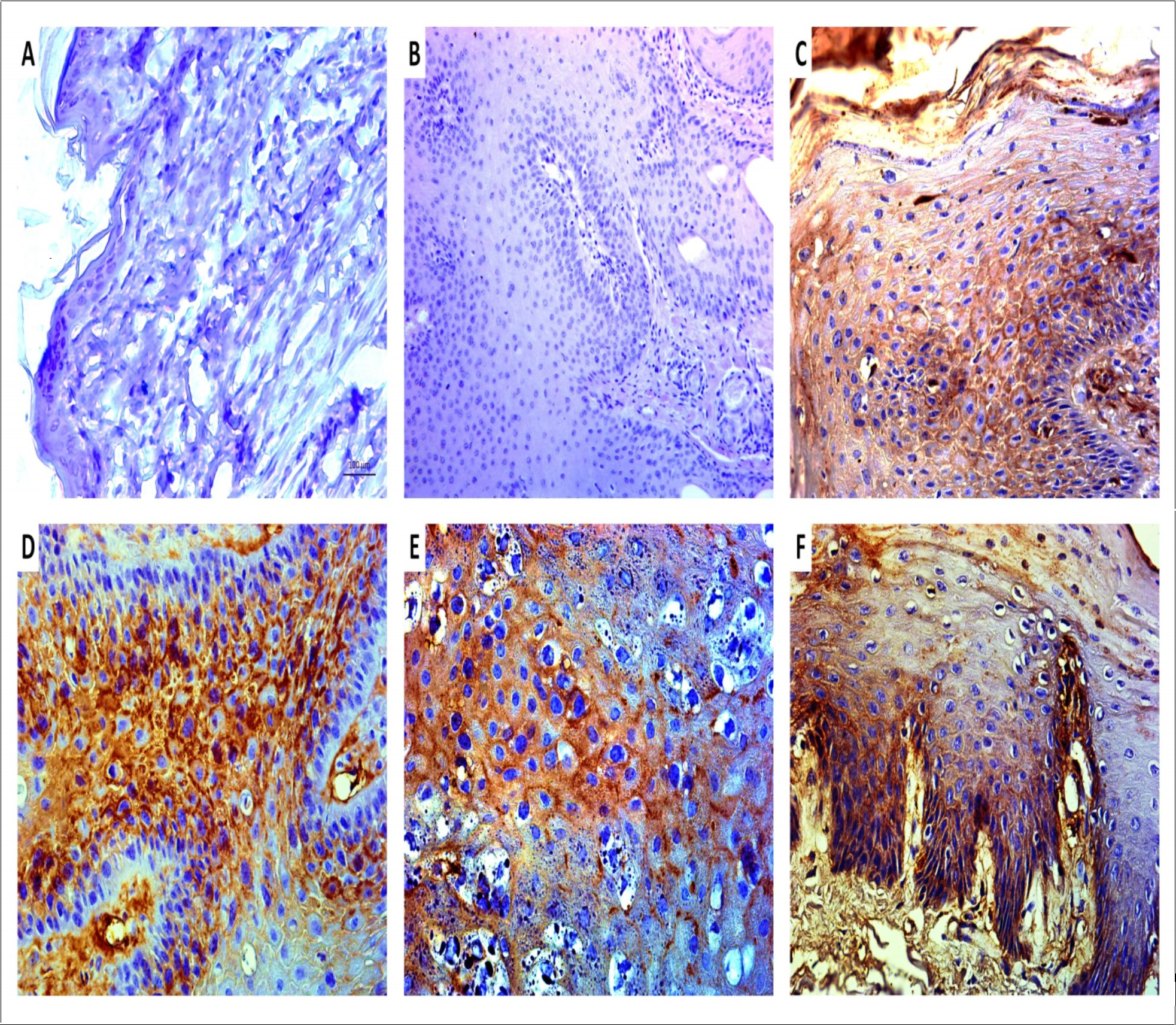 Immunodetection of BPV-1 E5 oncoprotein showing the absence of labeling in BPV-free normal skin (A), reinforcing the absence of virus infection in this tissue and, in negative control (B, cutaneous papilloma incubated exclusively with secondary antibody). The samples from cutaneous papilloma (C, papilloma 01), fibropapilloma (D and E – papilloma 02 and 03, respectively) and esophageal carcinoma (F) showed an evident expression of BPV-1 E5 oncoprotein, which was detected in both cytoplasm and plasmatic membrane, being in accordance with the protein biology, since the E5 is a hydrophobic transmembrane protein. Images obtained using objectives of 5X (B), 10X (A) and 20X (C-F).
