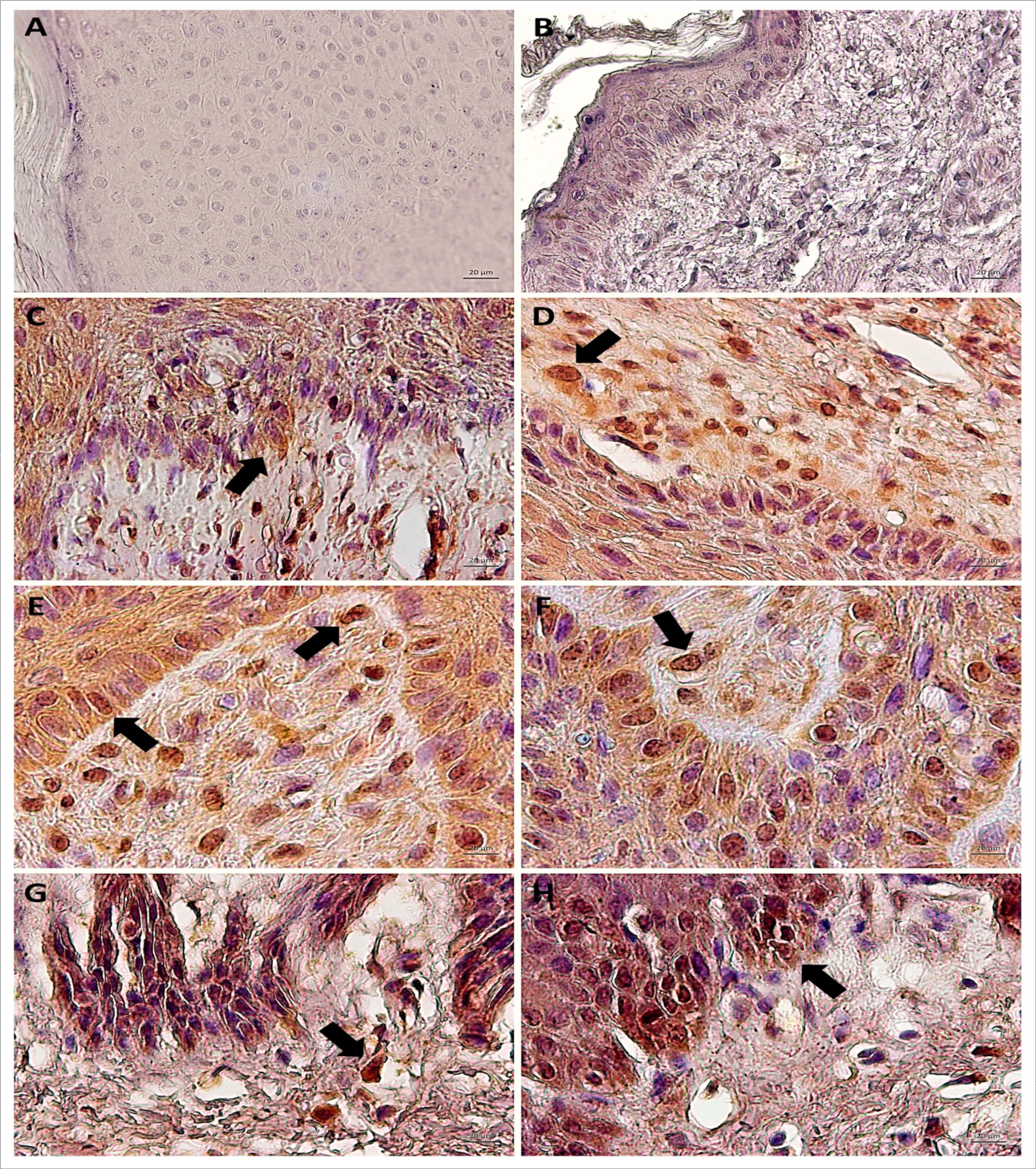  Immunodetection of STAT3 Y705 (active) showing the absence of expression in negative control  (A, cutaneous papilloma incubated exclusively with secondary antibody) and BPV-free normal skin (B). Results show the aberrant nuclear immunodetection of STAT3 Y705 cutaneous papilloma (C and D, papilloma 01),  fibropapilloma (E and F - papilloma 02 and 03, respectively) and esophageal carcinoma (G and H). The STAT3 Y705 expression was verified in keratinocyte-like cells present into the dermis. Images obtained using objectives of 10X (A, B, C and G) and 20X (D, E, F and H).
