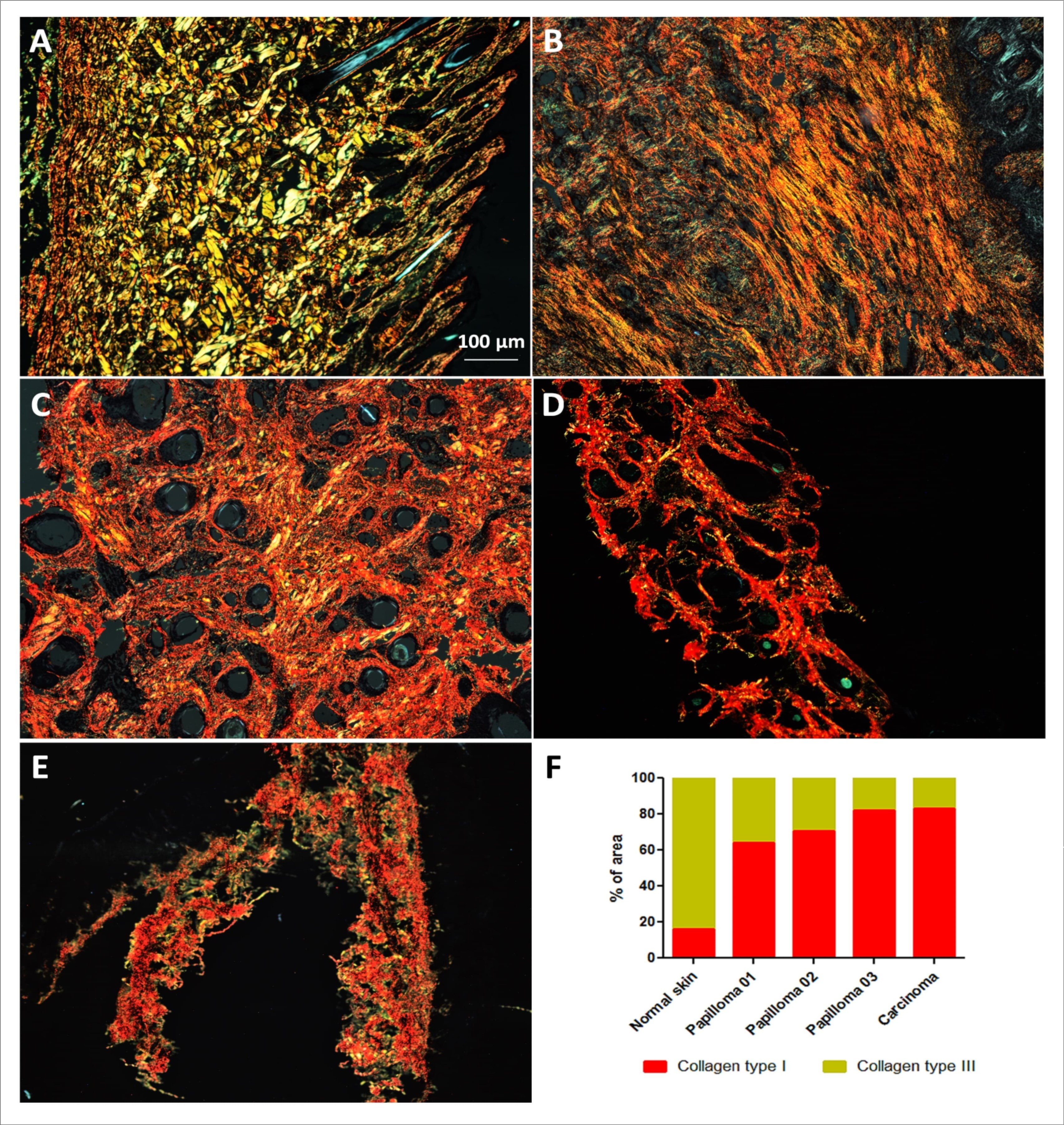  Analysis of collagen composition of extracellular matrix. Results show the prevalence of fibers type III in BPV-free normal skin (A) and the predominance of fibers type I in cutaneous papilloma (B, papilloma 01), fibropapilloma (C and D, papilloma 02 and 03, respectively) and esophageal carcinoma (E). Quantitative analysis using the software ImageJ, showing the increase of collagen type I in BPV-infected lesions. Images obtained using the objective of 5X.