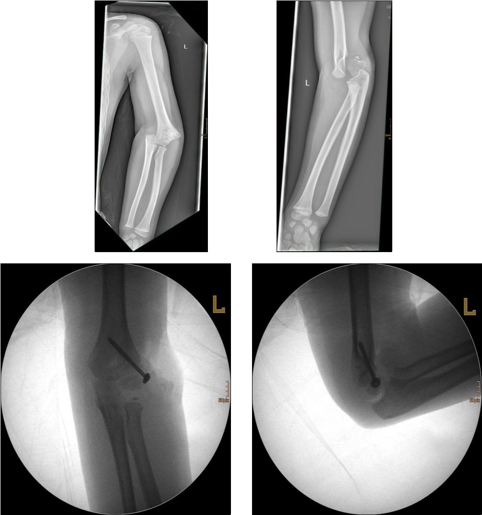  9 year old male patient with a elbow dislocation and a dislocated left lateral condyle fracture which was treated by open reduction and osteosynthesis with a screw (personal collection)