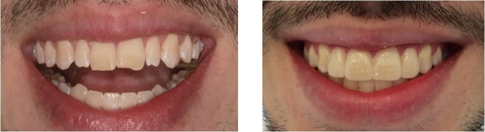 (a) Orthodontic treatment ending            (b) Mockup
