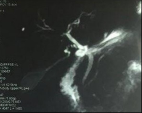  Magnetic resonance cholangiopancreatography showing multiple biliary strictures and parietal irregularities