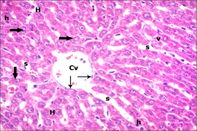  A photomicrograph of a section in the liver of ZnONPs & VE- treated adult                   albino rat showing slightly dilated sinusoids (s) and central vein (Cv) with flat                       endothelial lining (thin arrows). Most of hepatocytes are with vesicular nuclei and                  acidophilic cytoplasm (H). Others show darkly-stained nuclei (h) and less vacuolated cytoplasm (v). Binucleated cells (thick arrows) are also seen. (H&E  X400) 