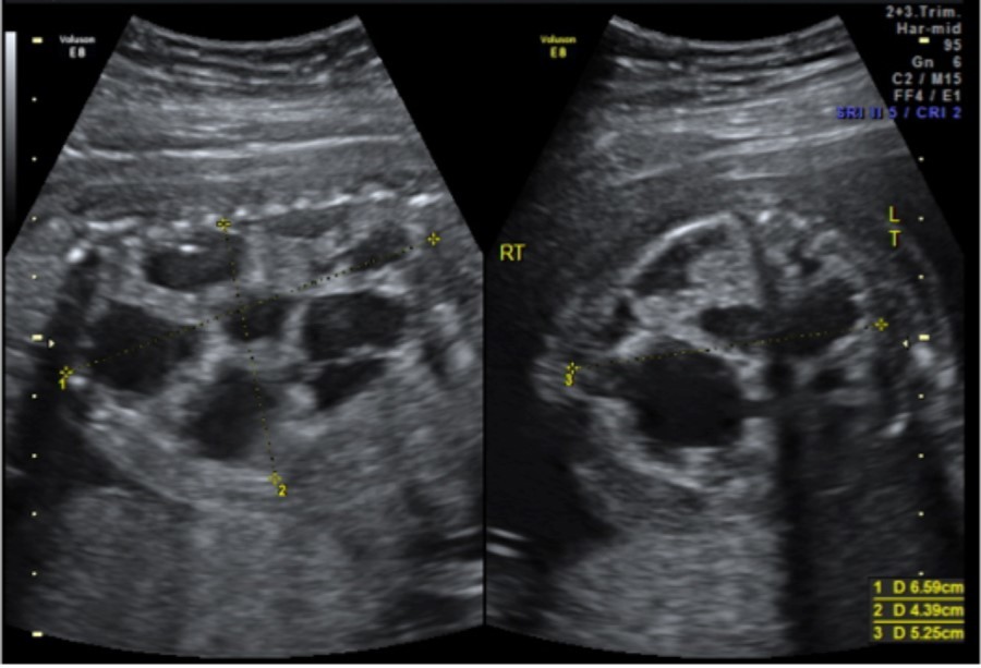  CPAM noted at initial fetal surgery consultation; sagittal view on the left and                 transverse view on the right