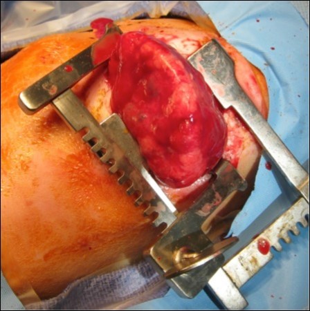  Neonatal thoracotomy