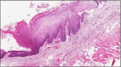  HCL Oral mucosa with soft tissue  infiltration of hairy cells(27).