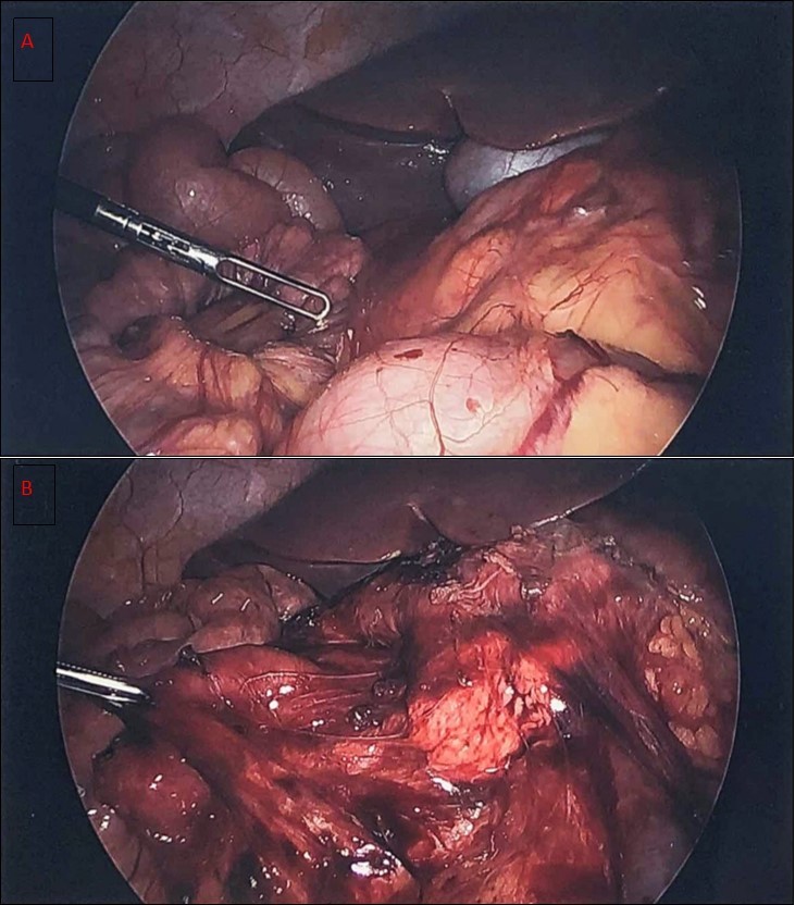  a) diagnostic laparoscopy showing Ladd’s bands b) liberation of the duodenum after the Ladd’s procedure with the small bowel to the right of the abdomen