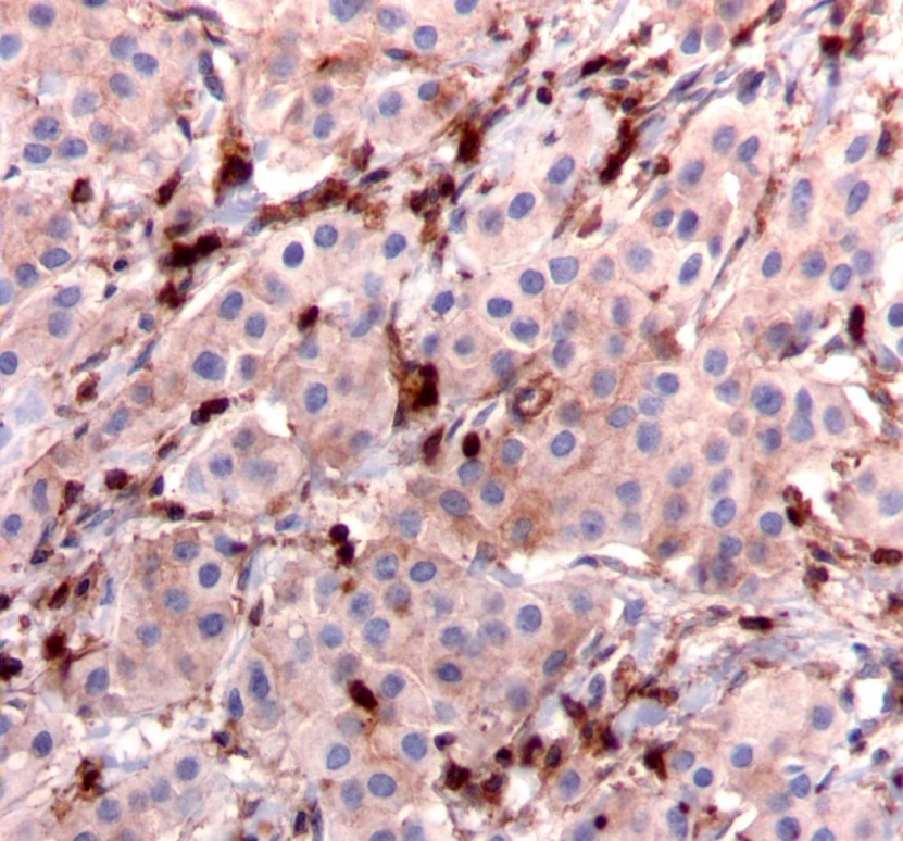  Diffuse cytoplasmic staining pattern for IRS-2. (IRS-2 immunohistochemical stain, 200x magnification)