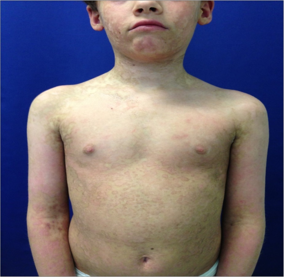  Six months follow up . Here we note trunk and neck with  no scar evidence. Skin hyperemia and dyschromia are still           present but with satisfactory cosmetic result and progressive         regression.