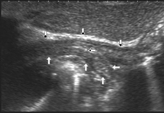  Ultrasonography of the abdominal esophagus (vertical arrows).  Horizontal arrow shows mucosa of the esophagus